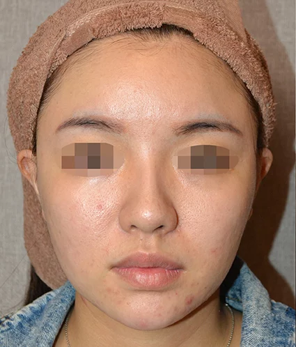 Before
