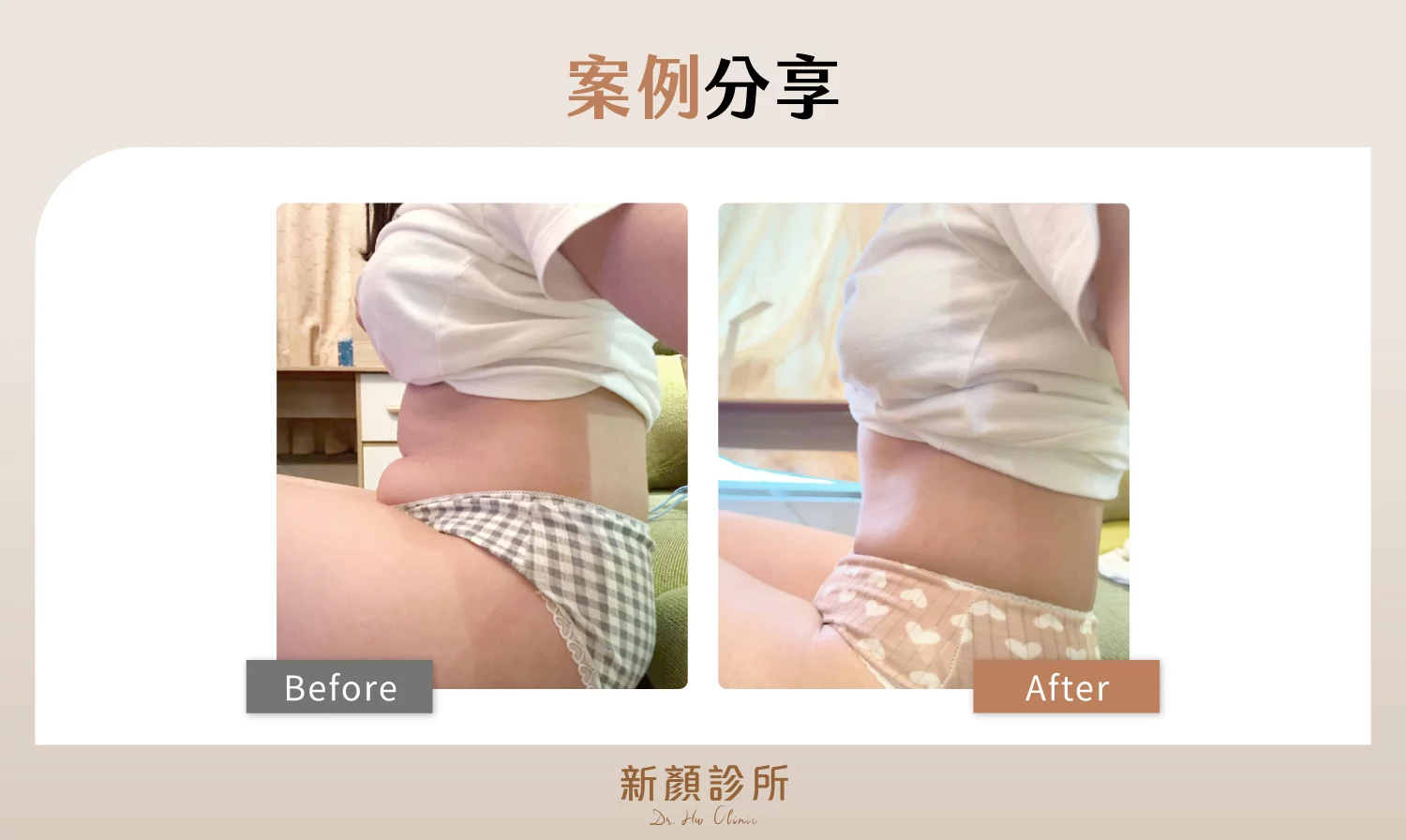 台北抽脂手術案例1