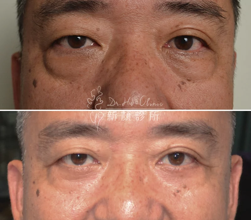 胡守丞醫師-外開眼袋