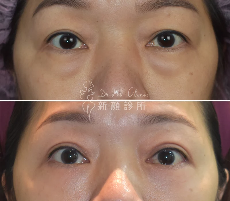 胡守丞醫師-外開眼袋