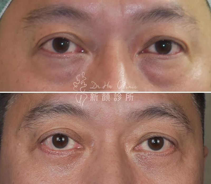 胡守丞醫師-外開眼袋