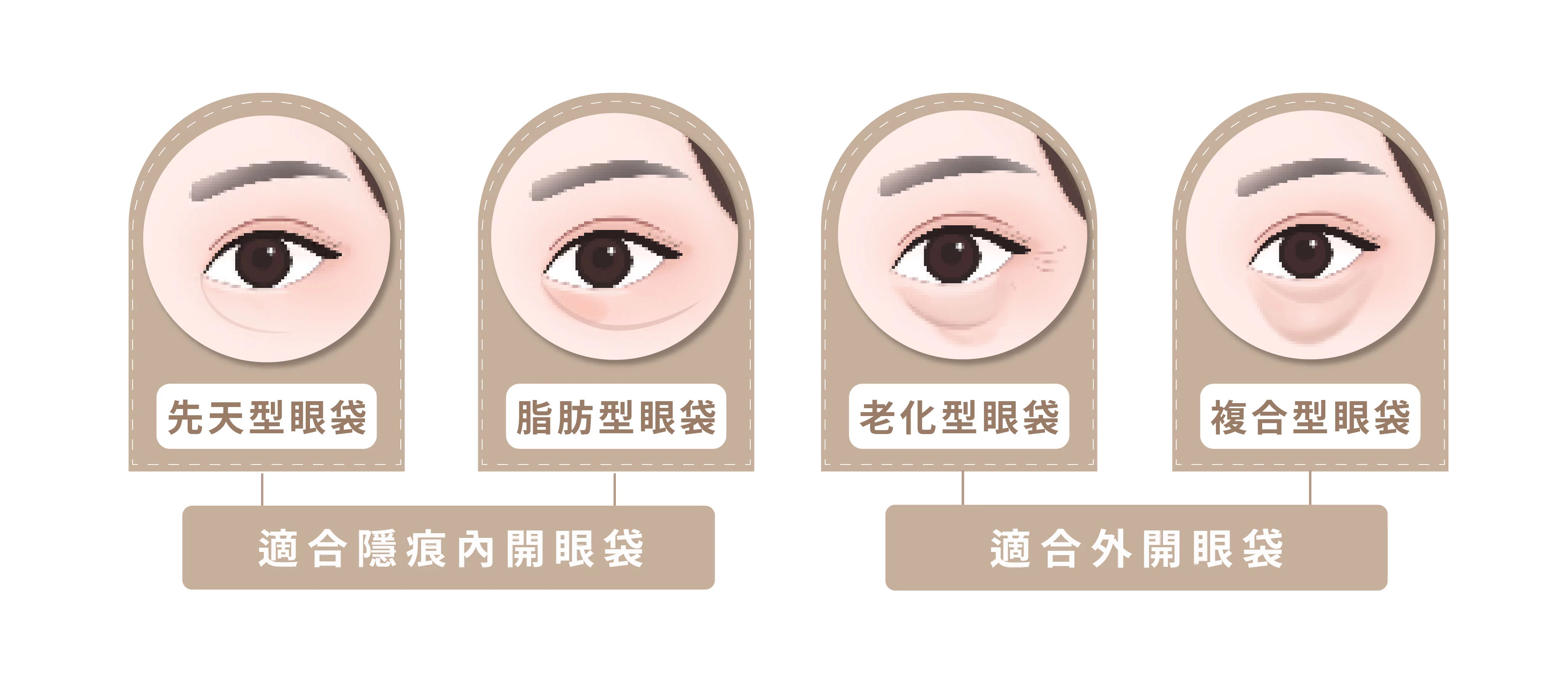 新顏診所-眼袋四大類型