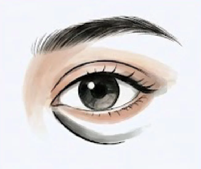 新顏診所-淚溝型眼袋