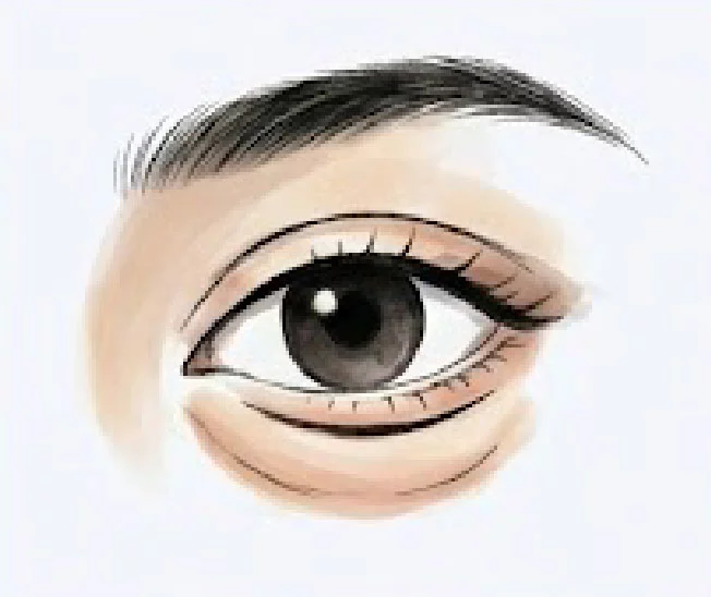 新顏診所-脂肪型眼袋