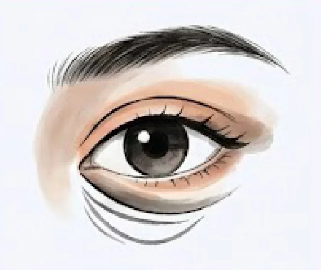 新顏診所-複合型眼袋