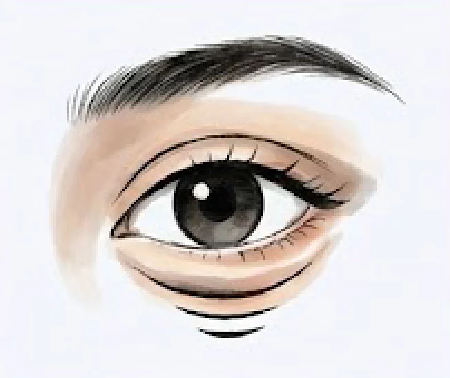 新顏診所-鬆弛型眼袋