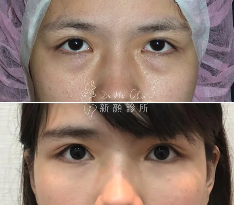 胡守丞醫師-複合式隱痕淚溝眼袋對比照