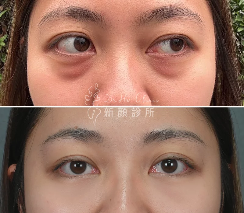 胡守丞醫師-複合式隱痕淚溝眼袋對比照