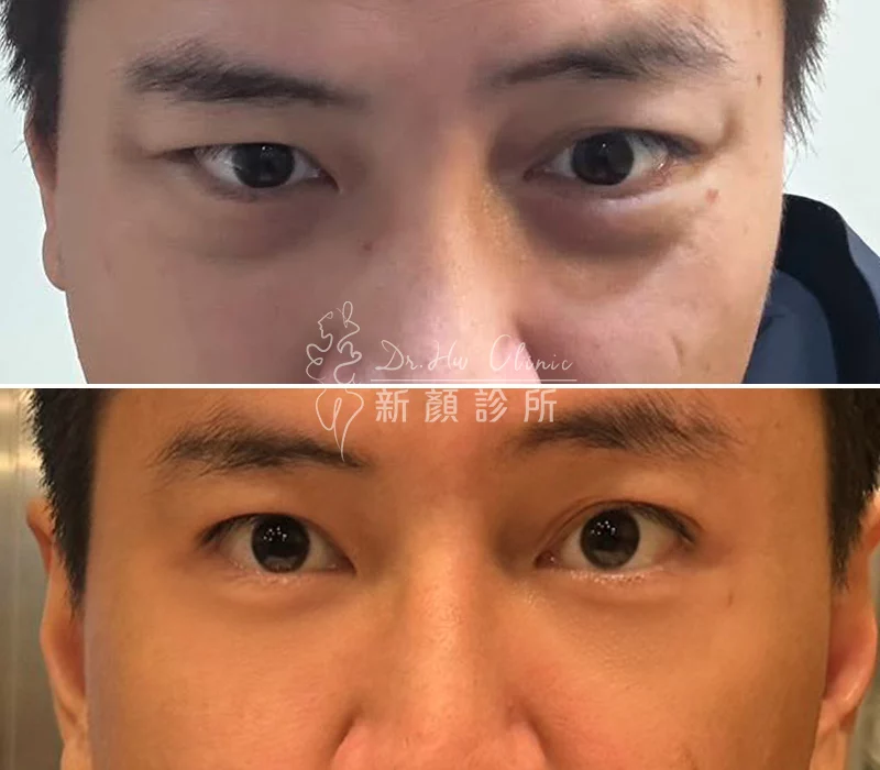 胡守丞醫師-複合式隱痕淚溝眼袋對比照