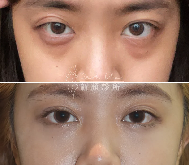 胡守丞醫師-複合式隱痕淚溝眼袋對比照