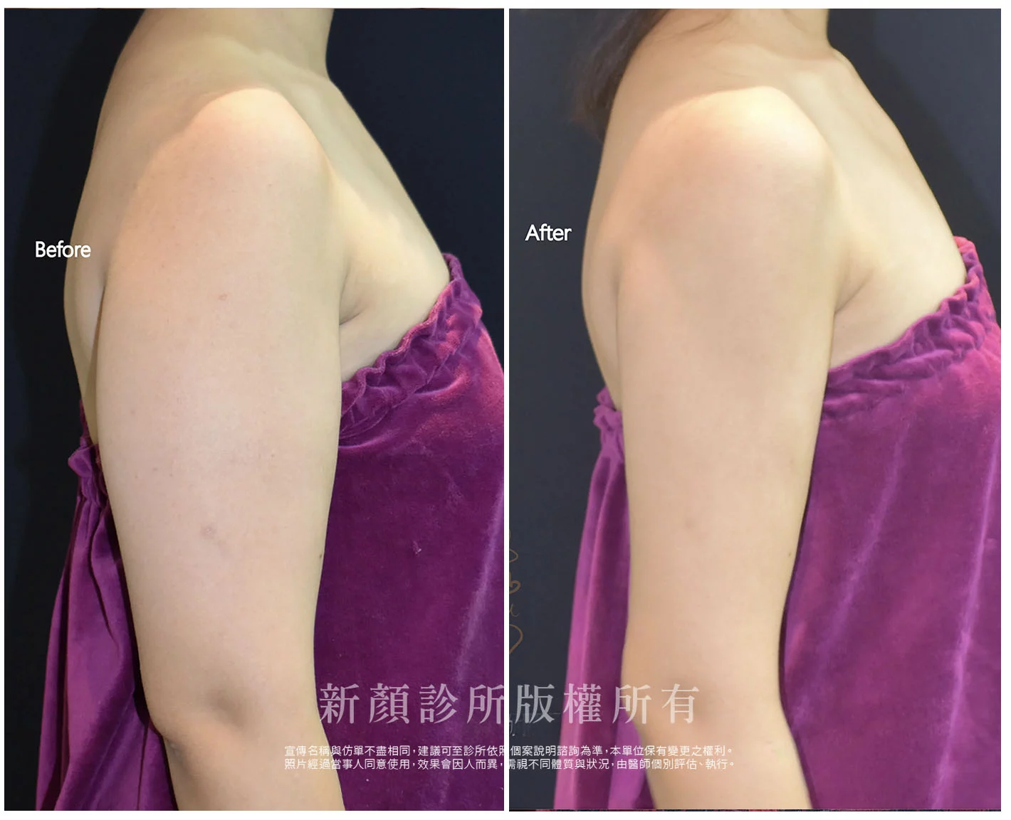 胡守丞醫師-微創威塑抽脂案例-VASER抽脂-新顏診所