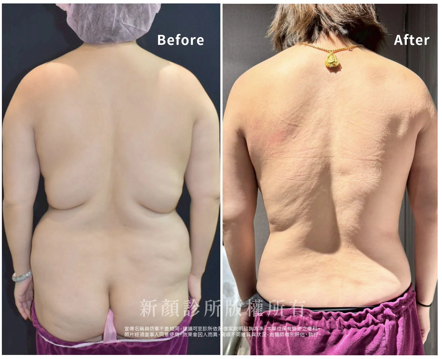 胡守丞醫師-微創威塑抽脂案例-VASER抽脂-新顏診所