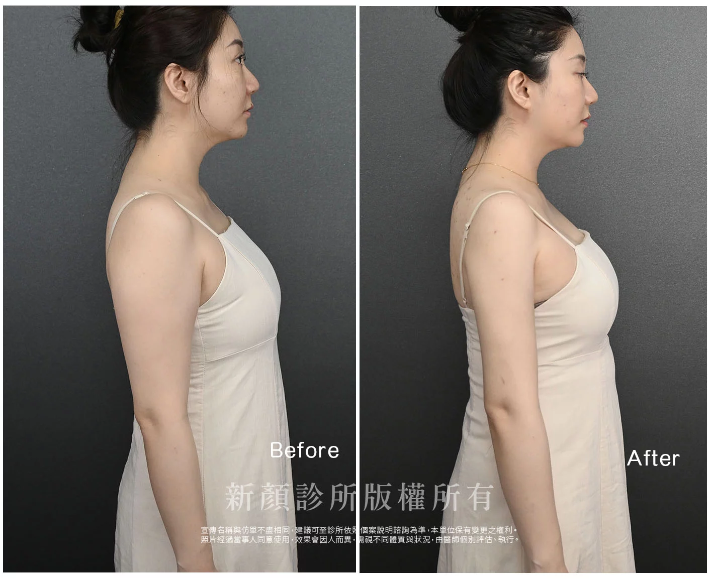 胡守丞醫師-微創威塑抽脂案例-VASER抽脂-新顏診所