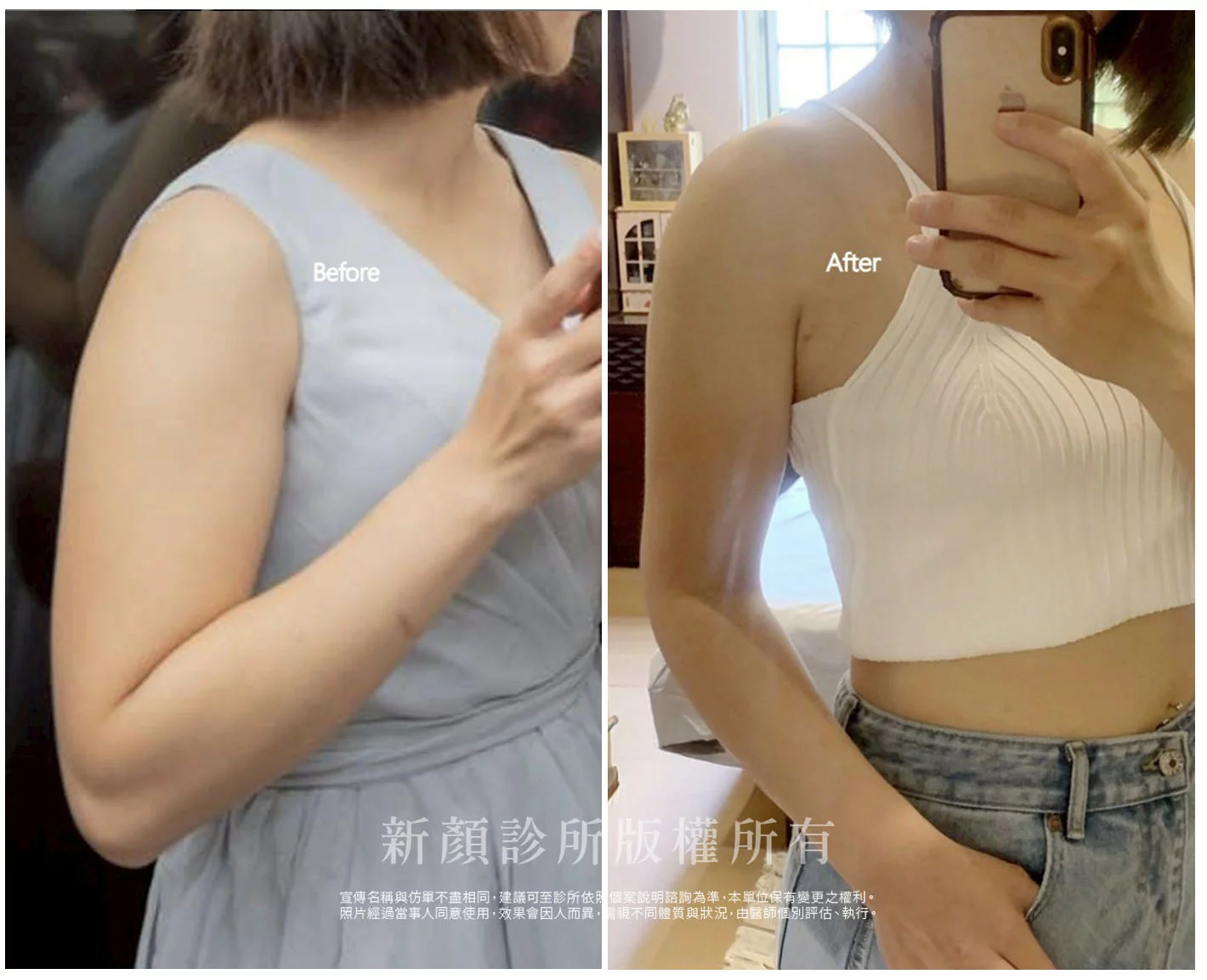 胡守丞醫師-微創威塑抽脂案例-VASER抽脂-新顏診所