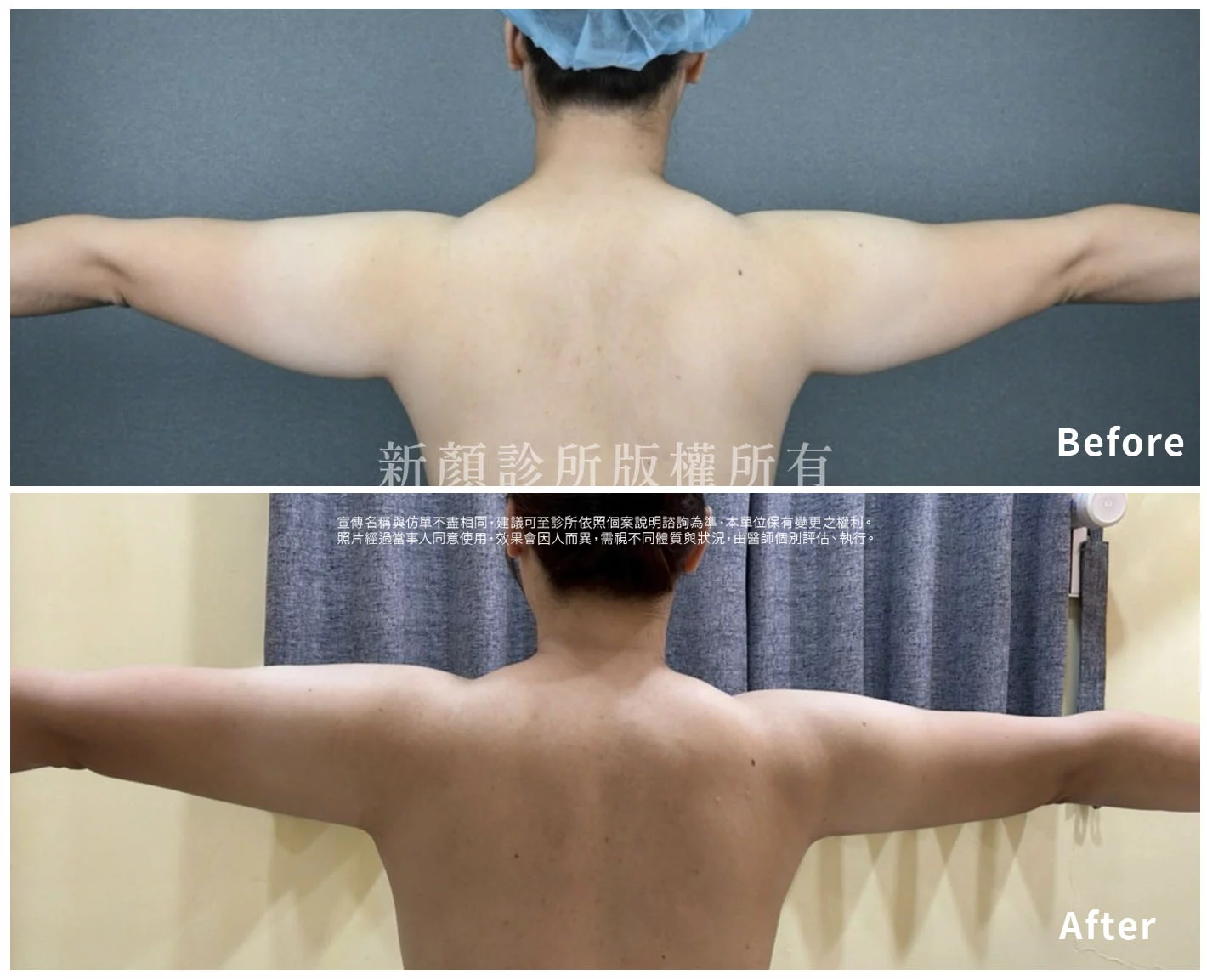 胡守丞醫師-微創威塑抽脂案例-VASER抽脂-新顏診所