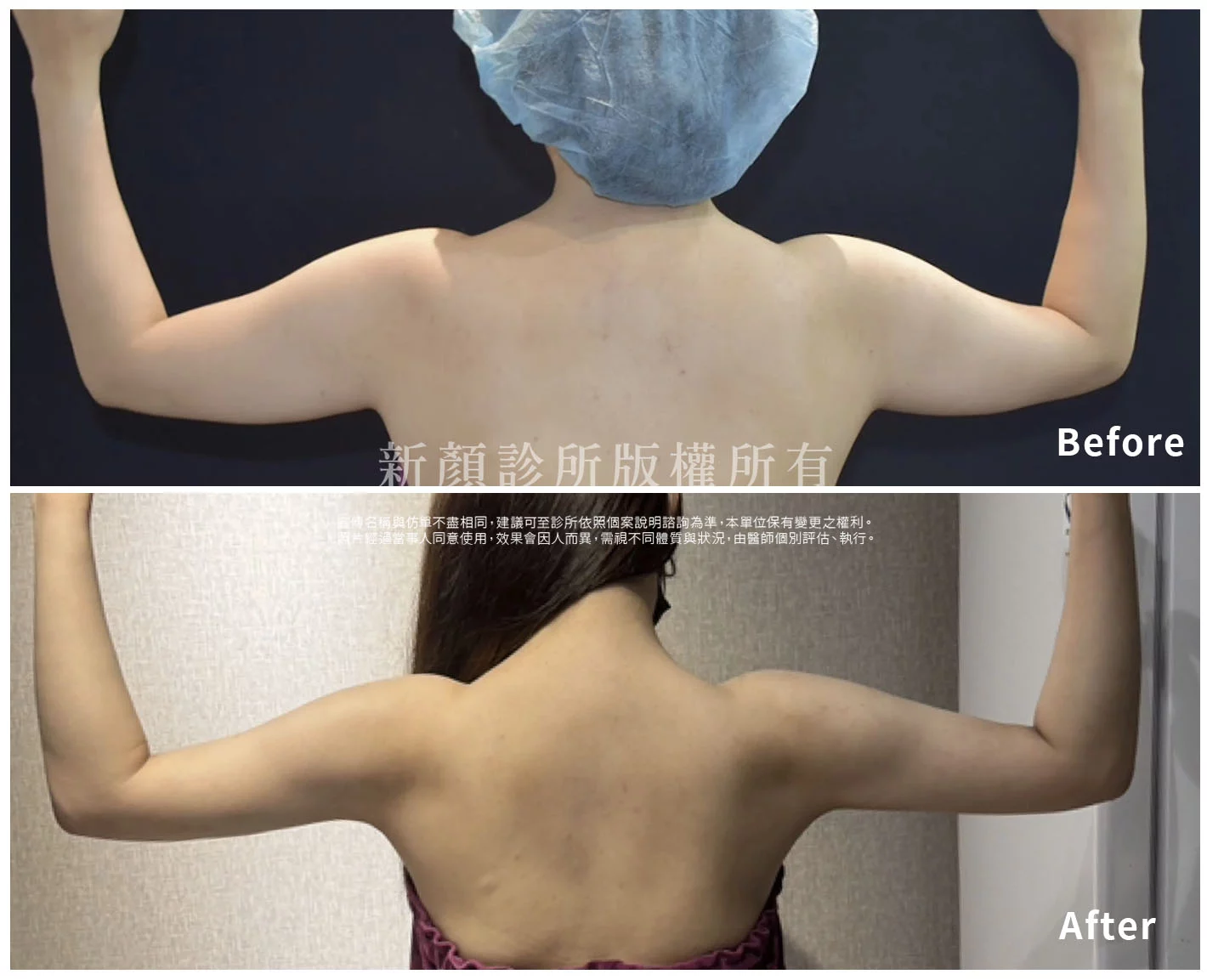 胡守丞醫師-微創威塑抽脂案例-VASER抽脂-新顏診所