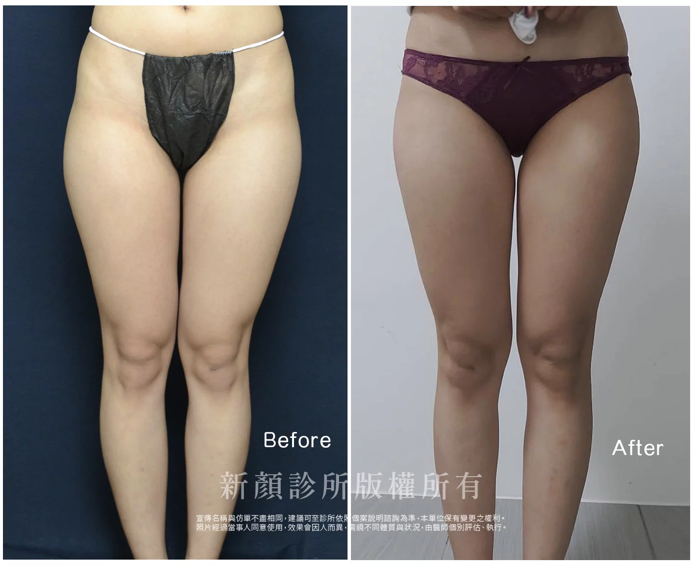 胡守丞醫師-微創威塑抽脂案例-VASER抽脂-新顏診所