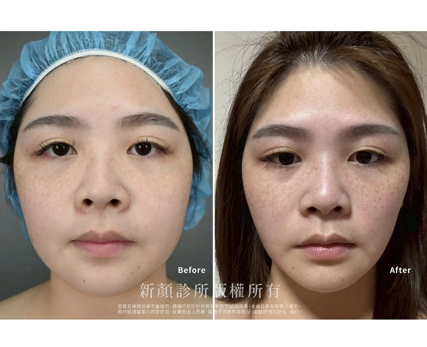 胡守丞醫師-微創威塑抽脂案例-VASER抽脂-新顏診所