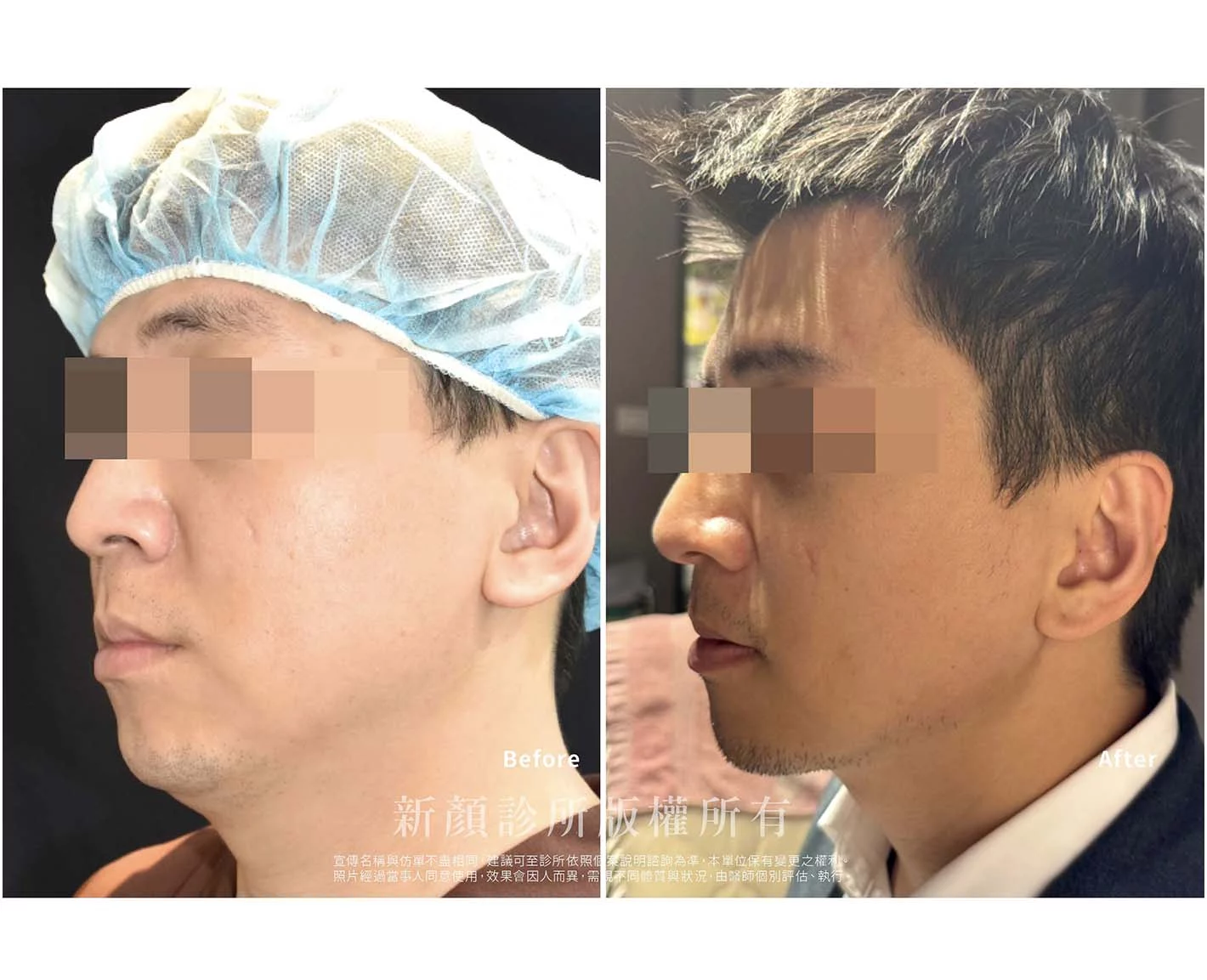 胡守丞醫師-微創威塑抽脂案例-VASER抽脂-新顏診所