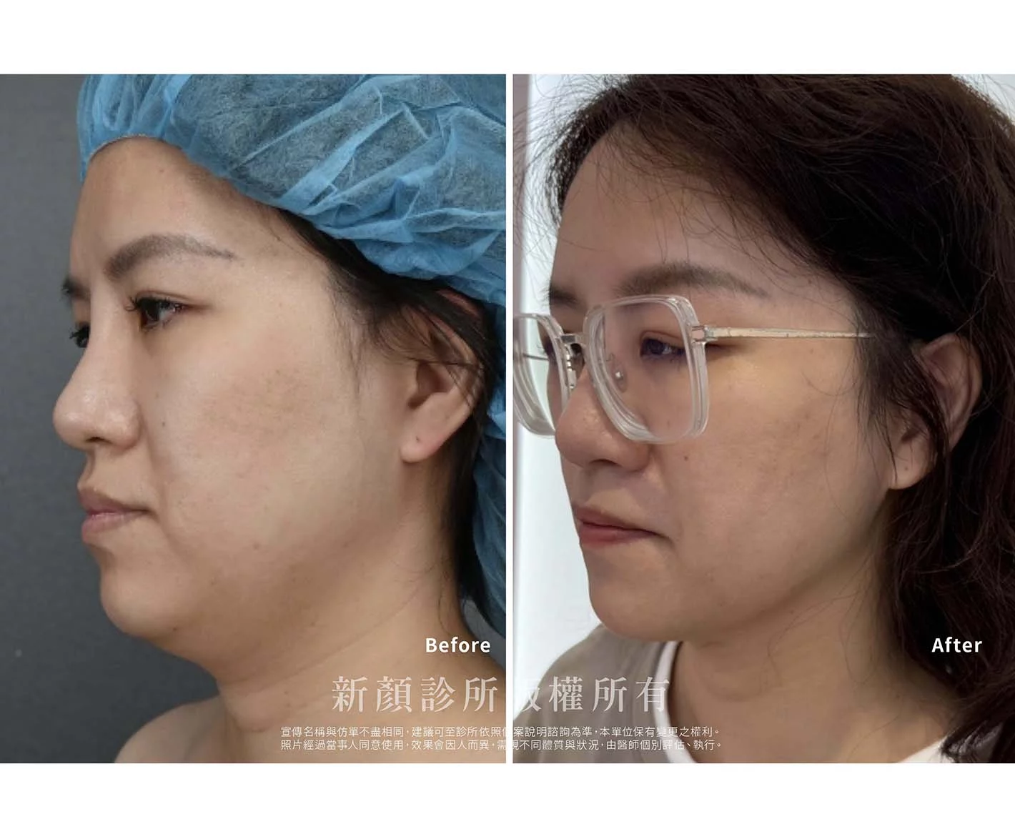 胡守丞醫師-微創威塑抽脂案例-VASER抽脂-新顏診所