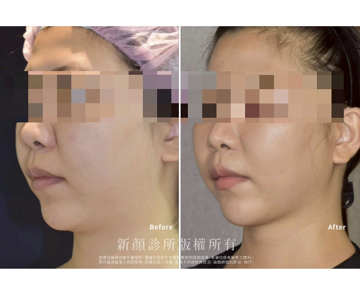 胡守丞醫師-微創威塑抽脂案例-VASER抽脂-新顏診所