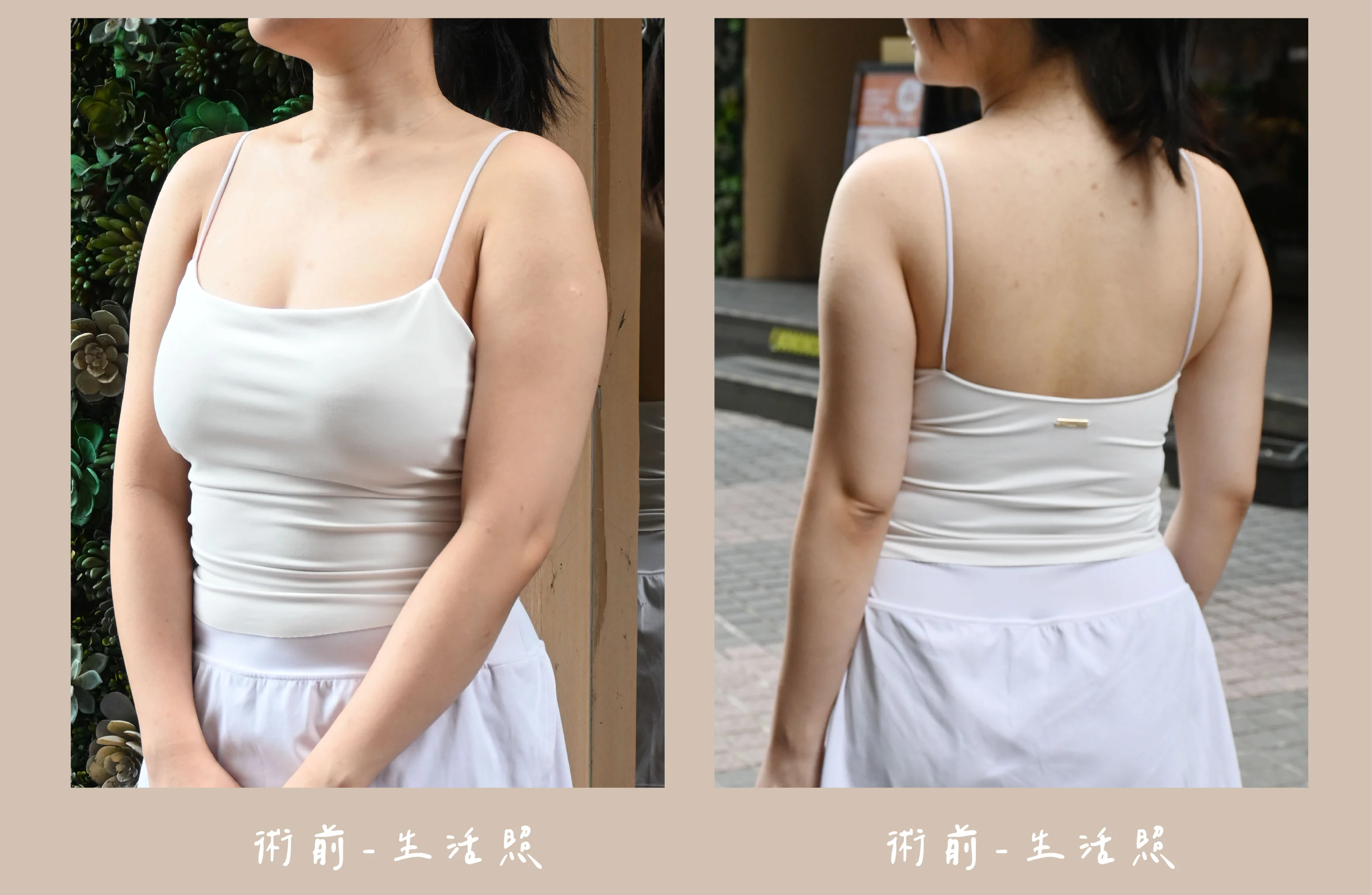 胡守丞院長-威塑2.2抽脂-手臂環抽 術前生活照