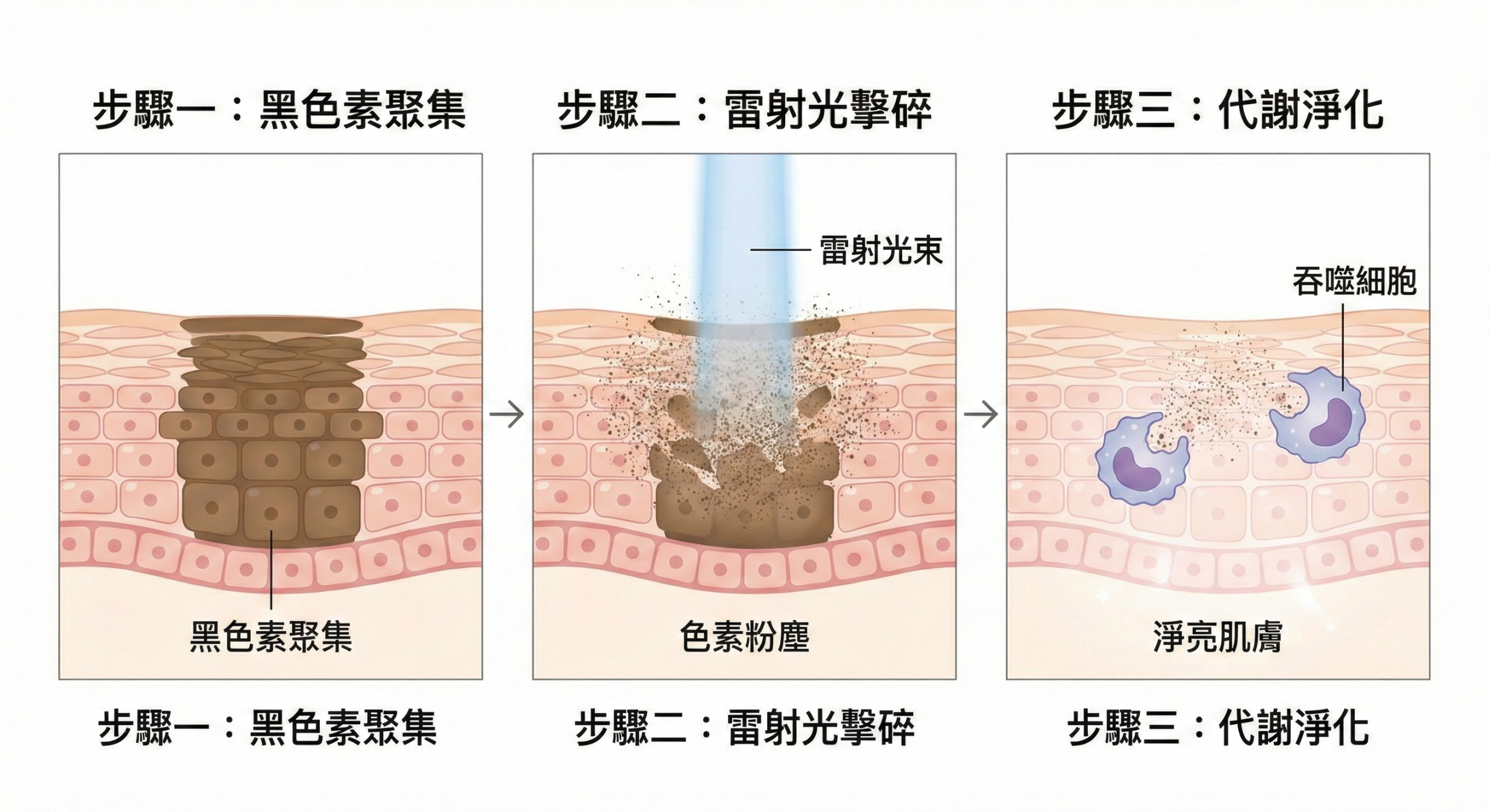 新顏診所_淨膚雷射打擊黑色素