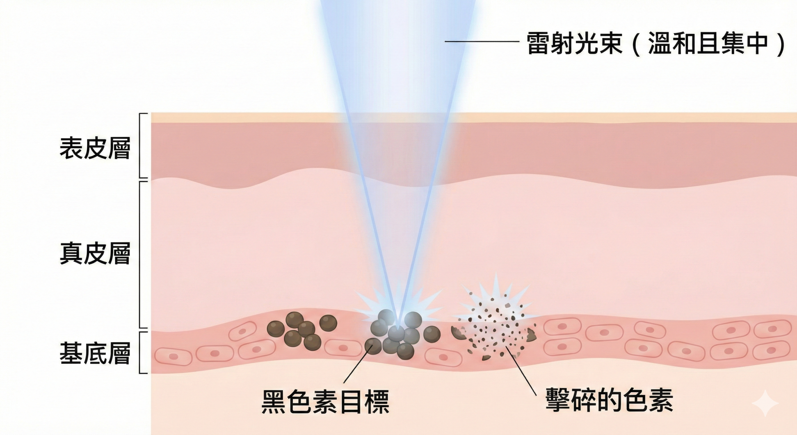 新顏診所_淨膚雷射療程原理