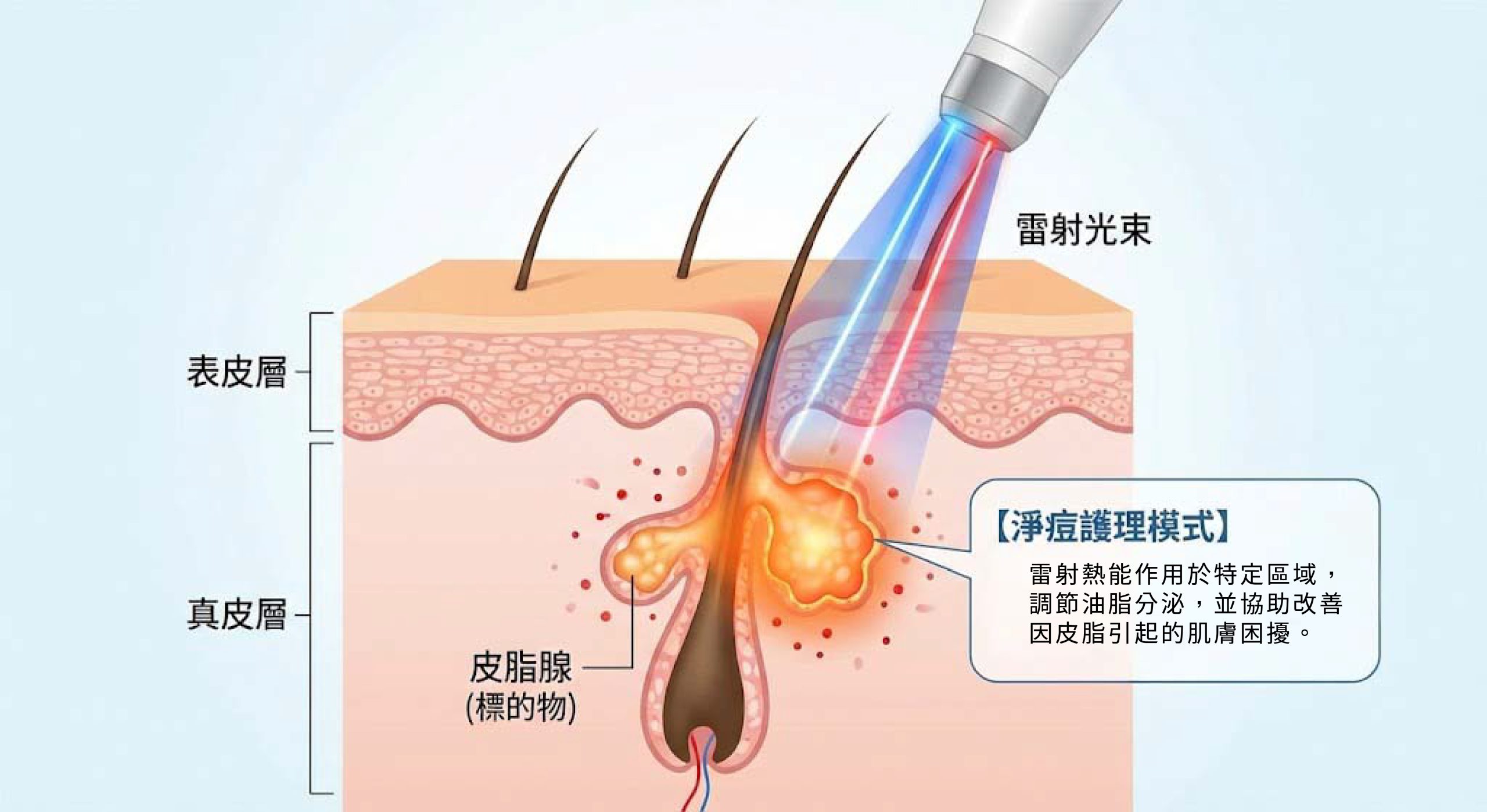 新顏診所_粉餅雷射(二極體)