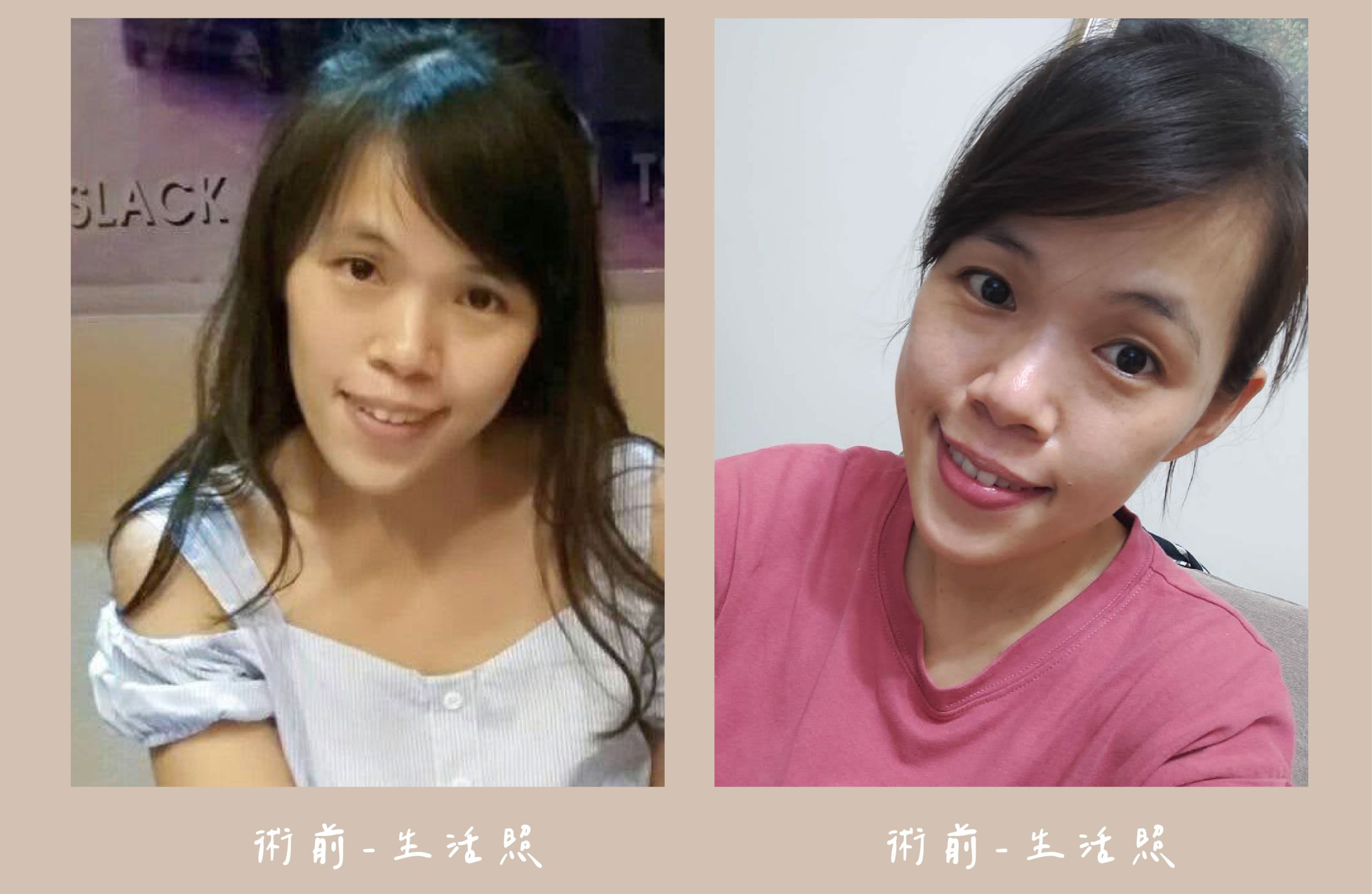 胡守丞醫師-臉部補脂術前生活照