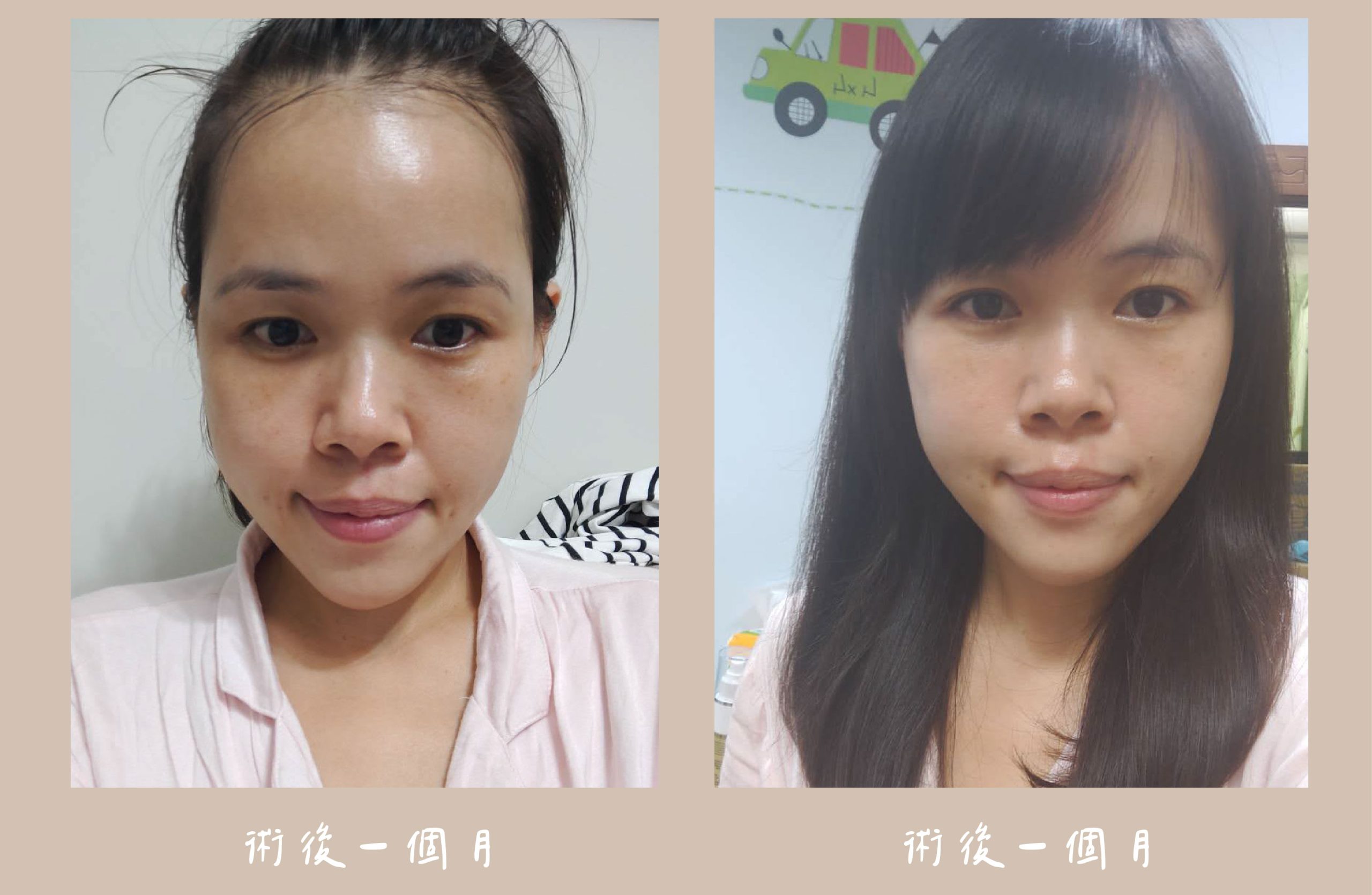 胡守丞醫師-臉部補脂術後一個月