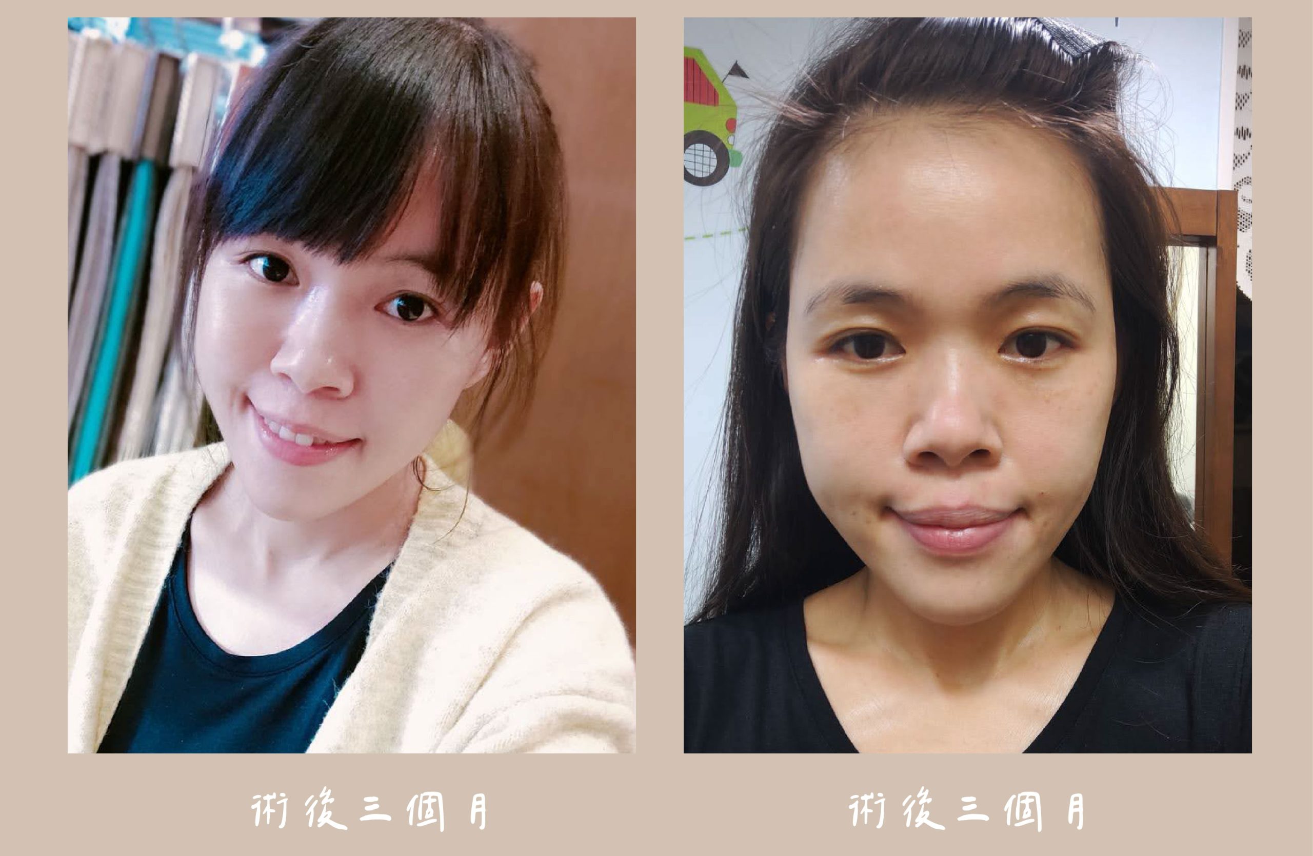 胡守丞醫師-臉部補脂術後生活照