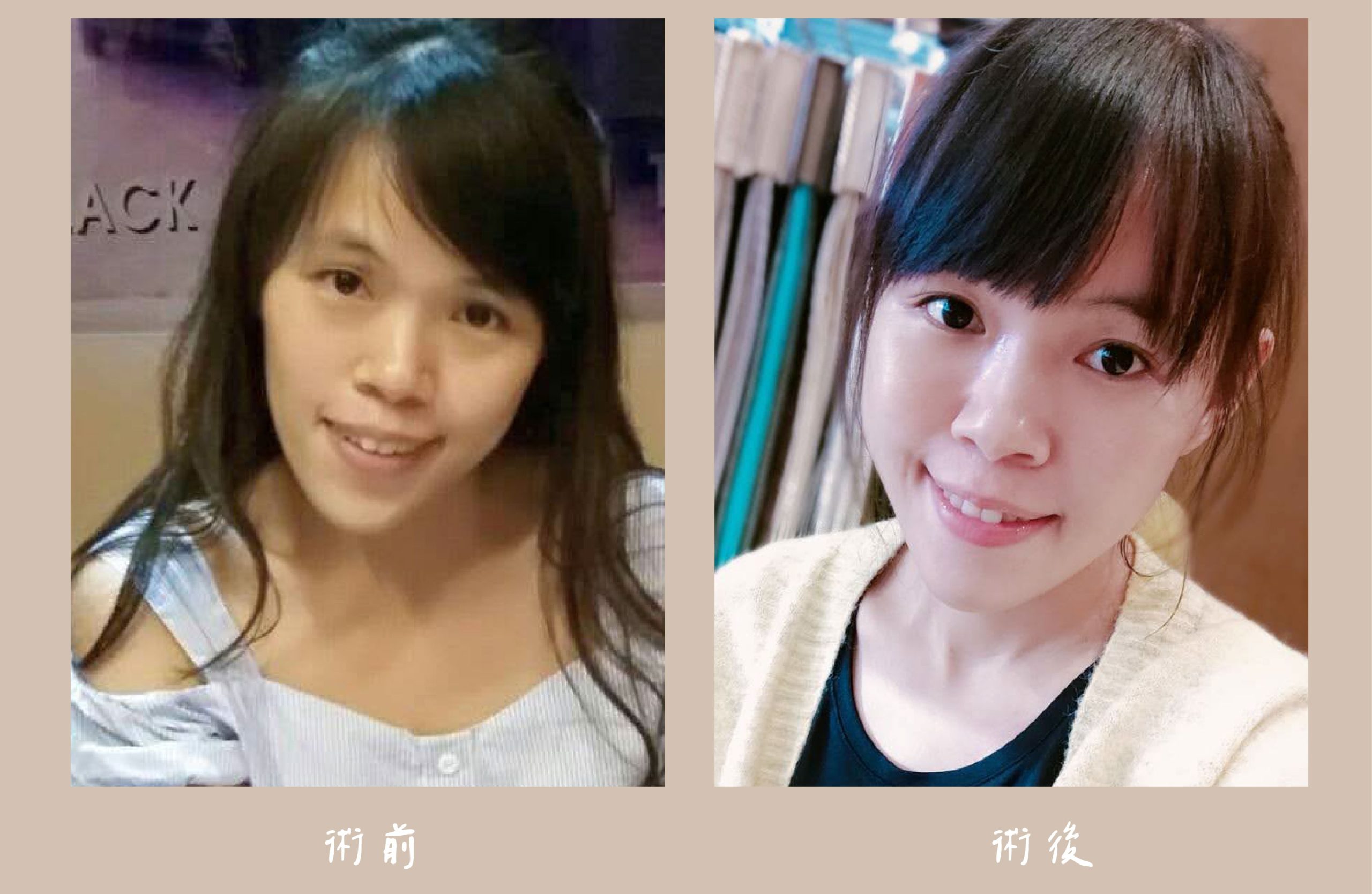 胡守丞醫師-臉部補脂_術前&術後