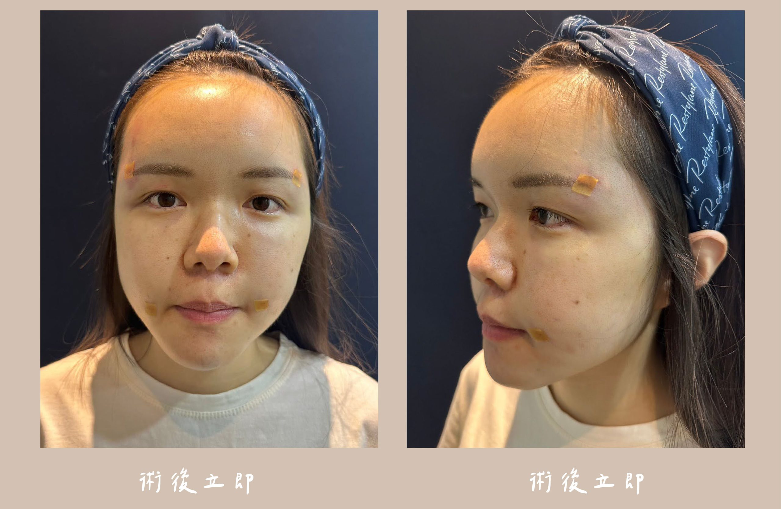 胡守丞醫師-臉部補脂術後立即