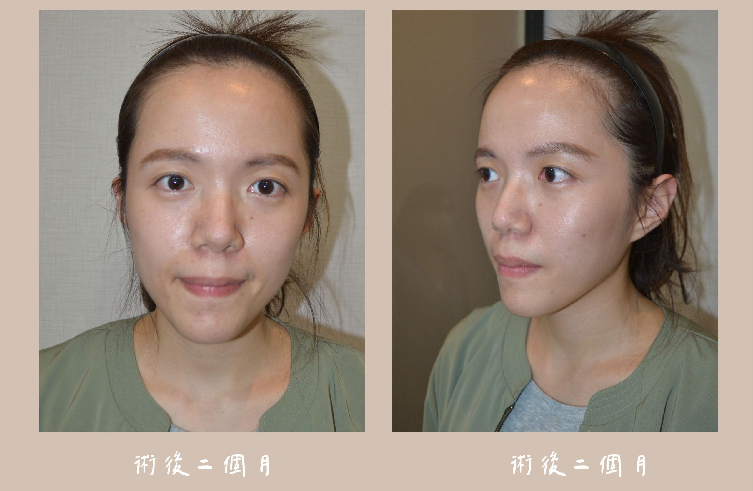 胡守丞醫師-臉部補脂術後2個月