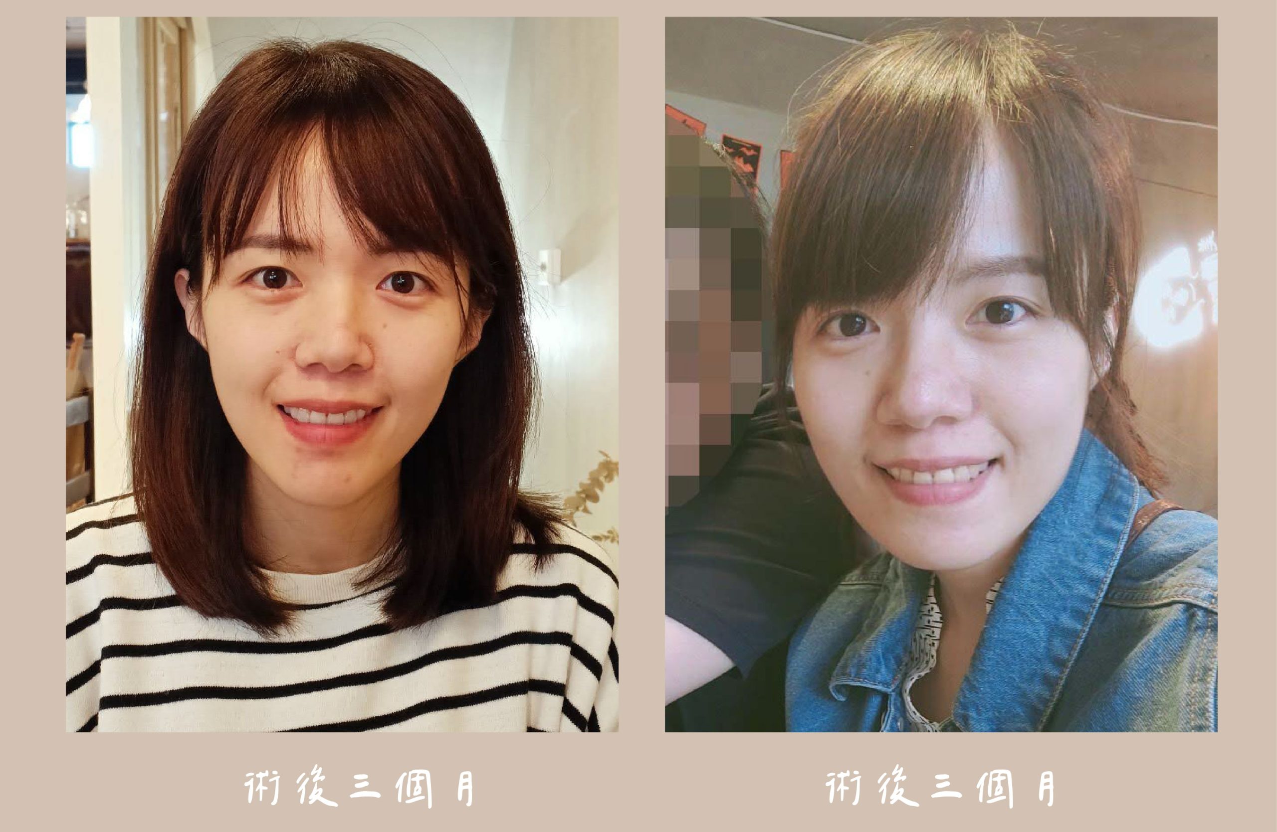 胡守丞醫師-臉部補脂術後3個月