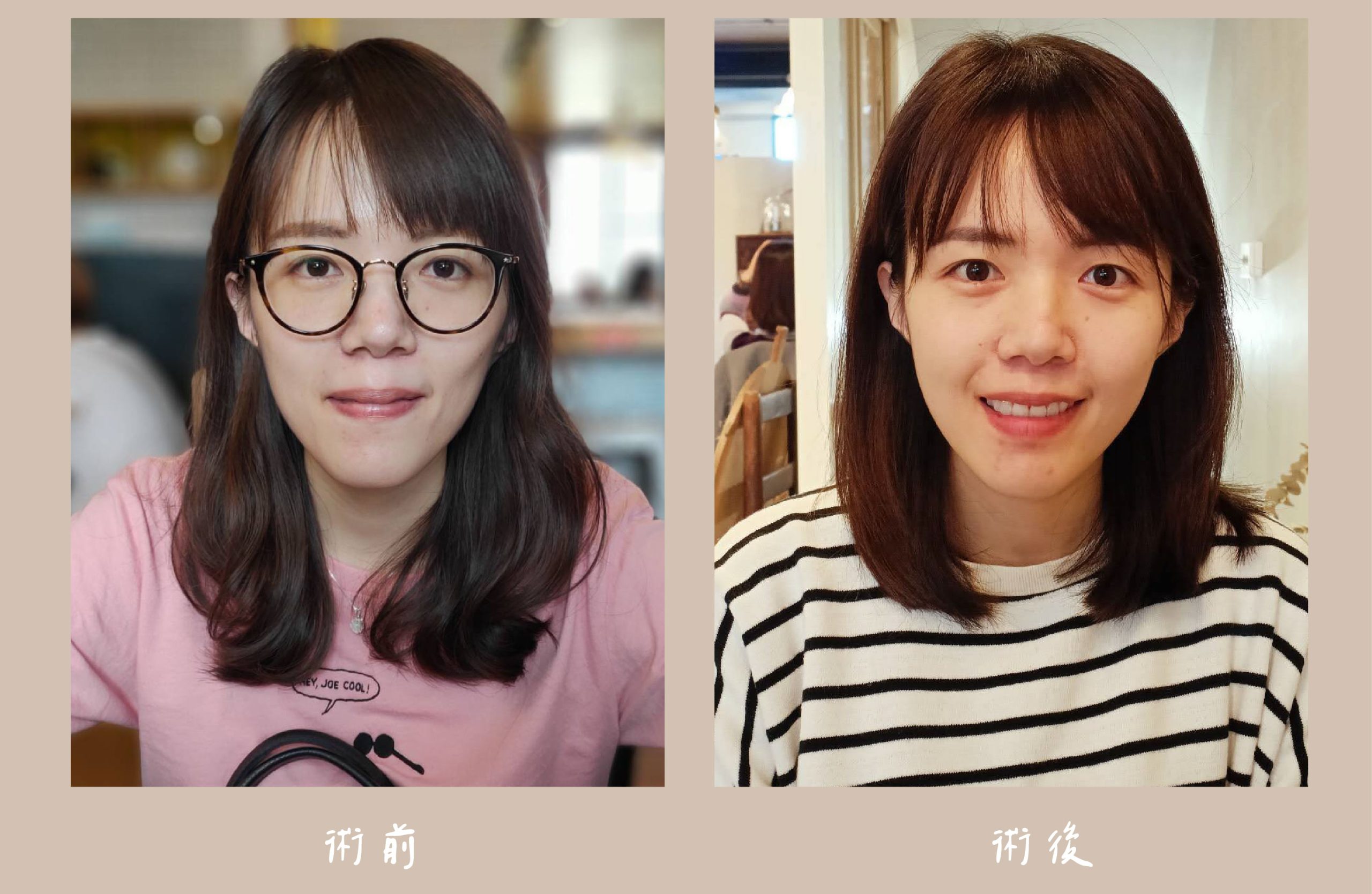 胡守丞醫師-臉部補脂_術前&術後