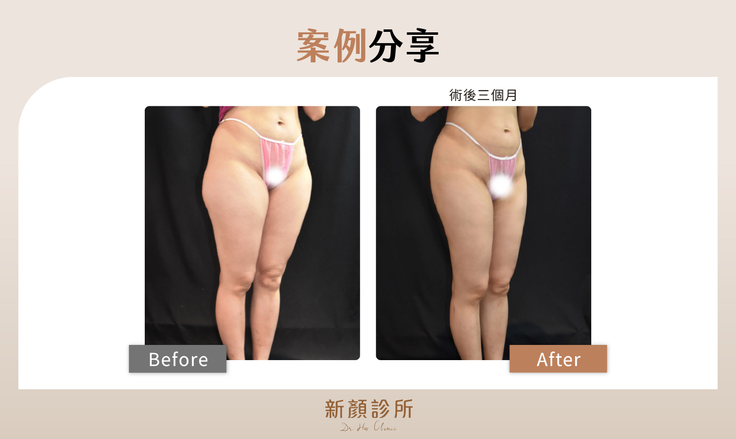 自體豐胸案例分享