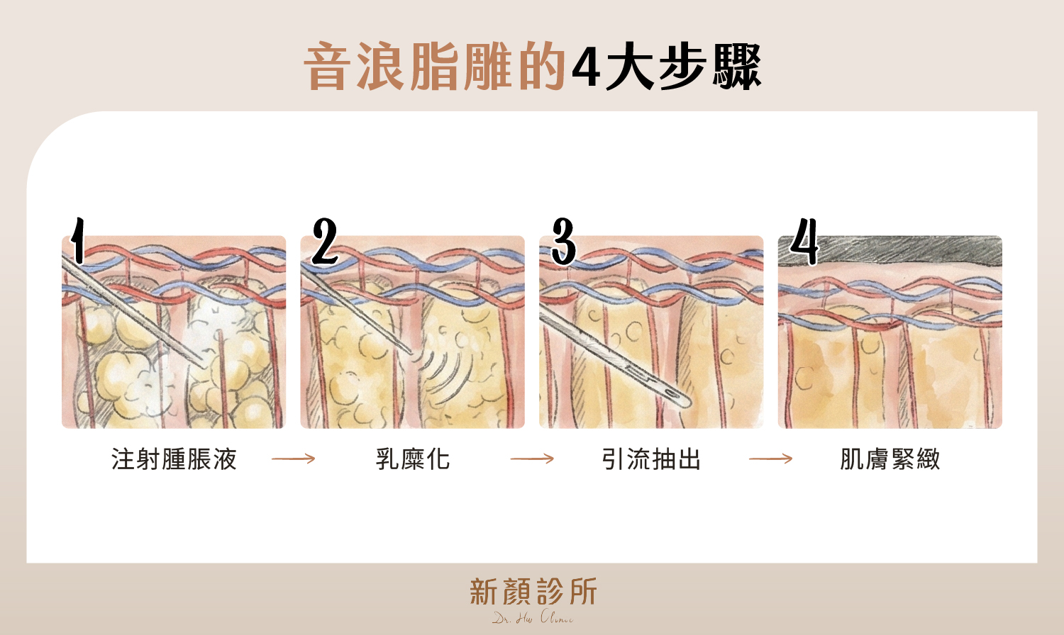 lssa 音浪脂雕步驟