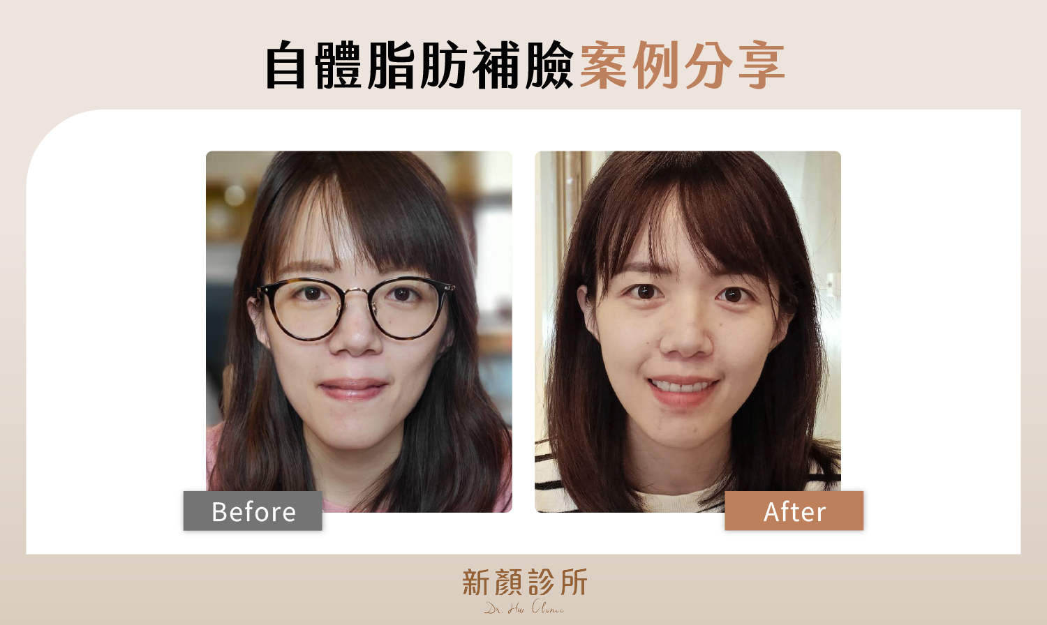 自體脂肪補臉多久自然 案例分享