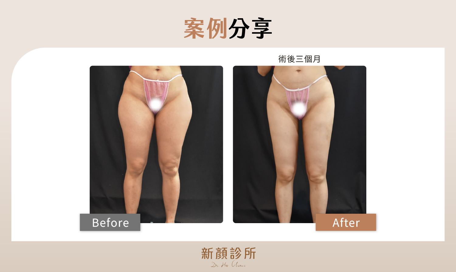 台北抽脂補胸案例分享