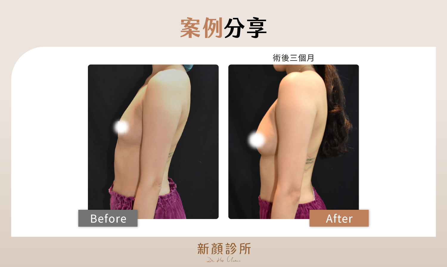 台北抽脂補胸案例分享