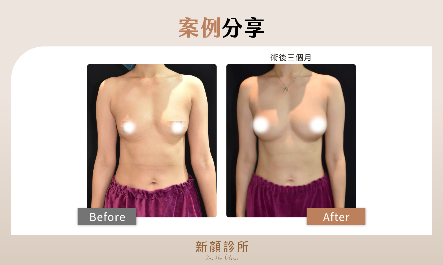 台北抽脂補胸案例分享
