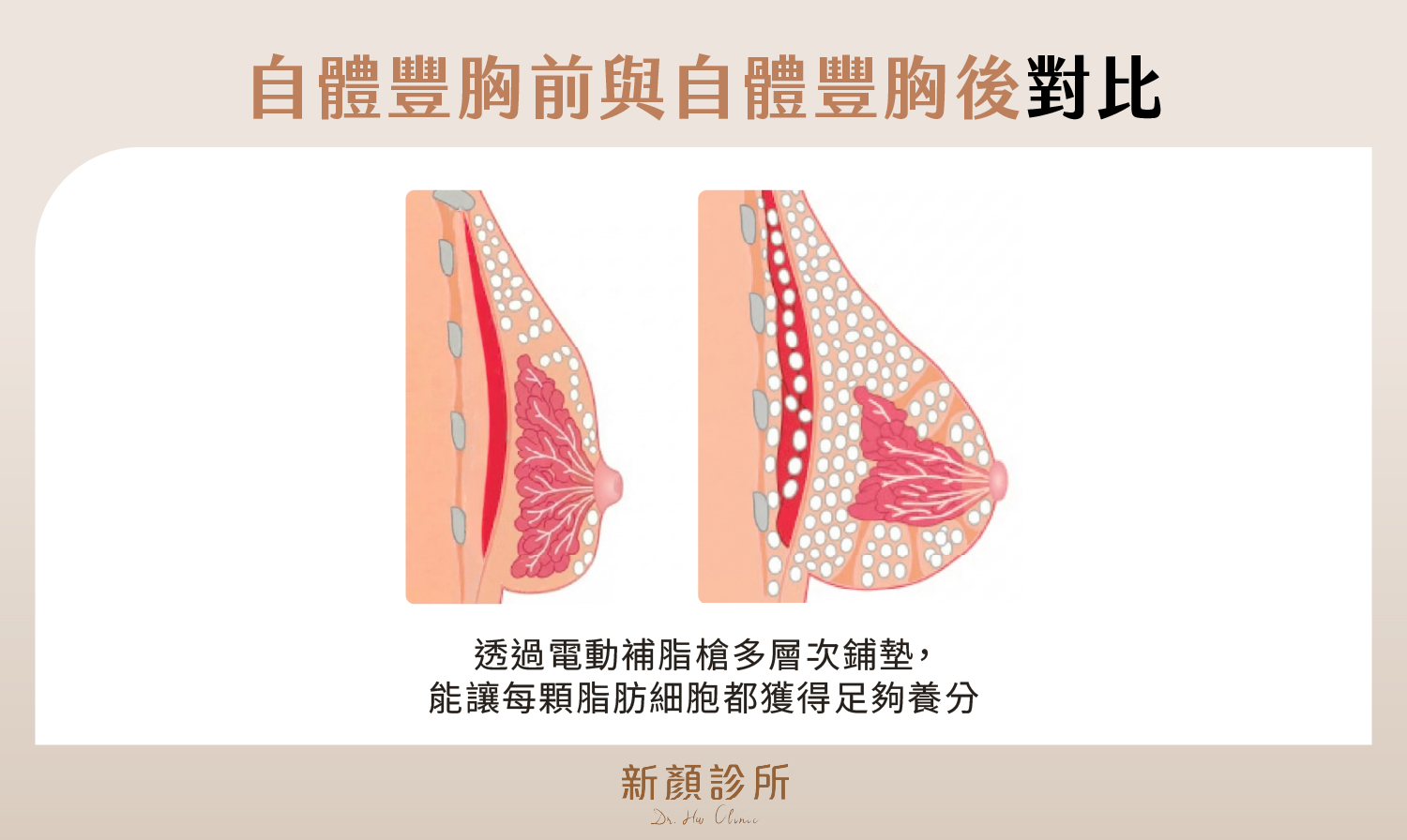 自體豐胸前後對比