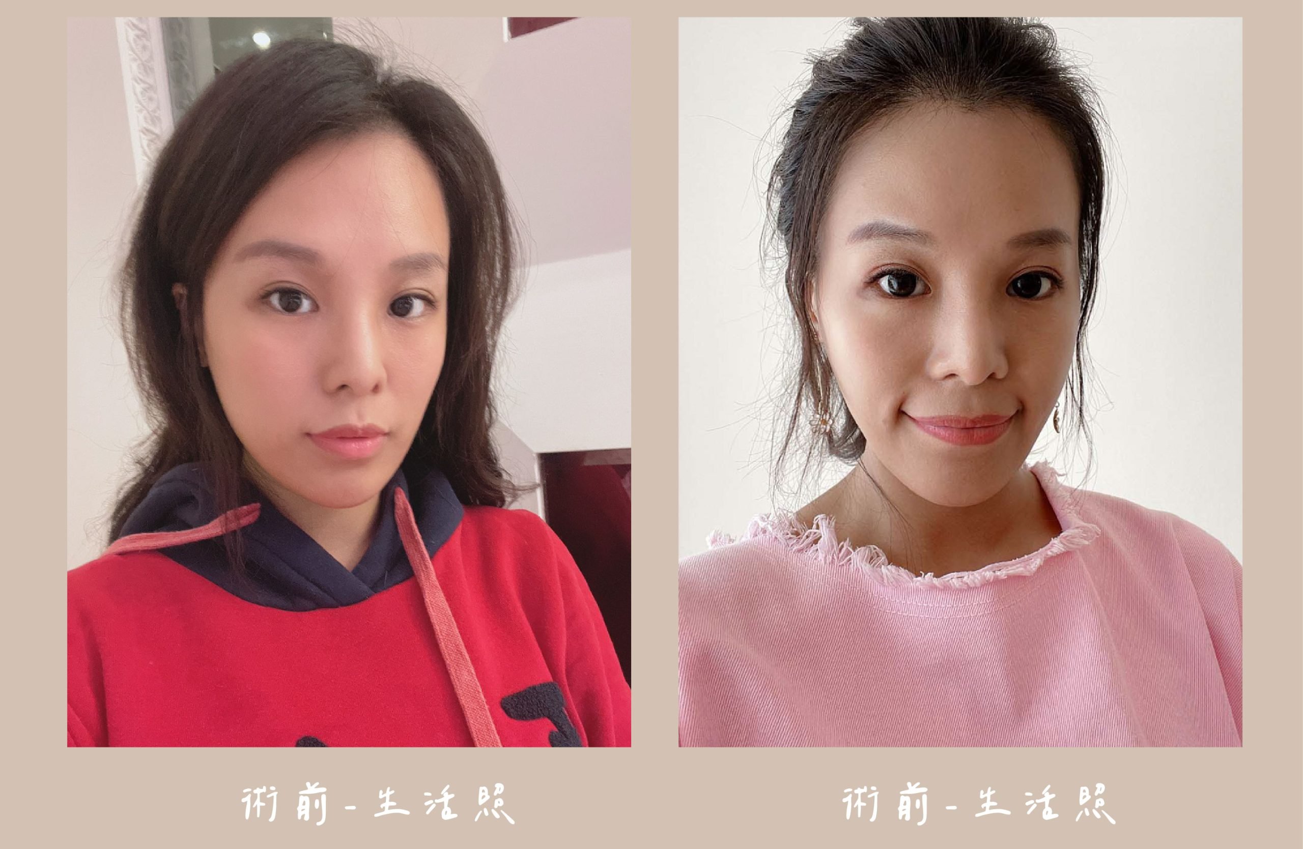 胡守丞醫師-臉部補脂術前生活照