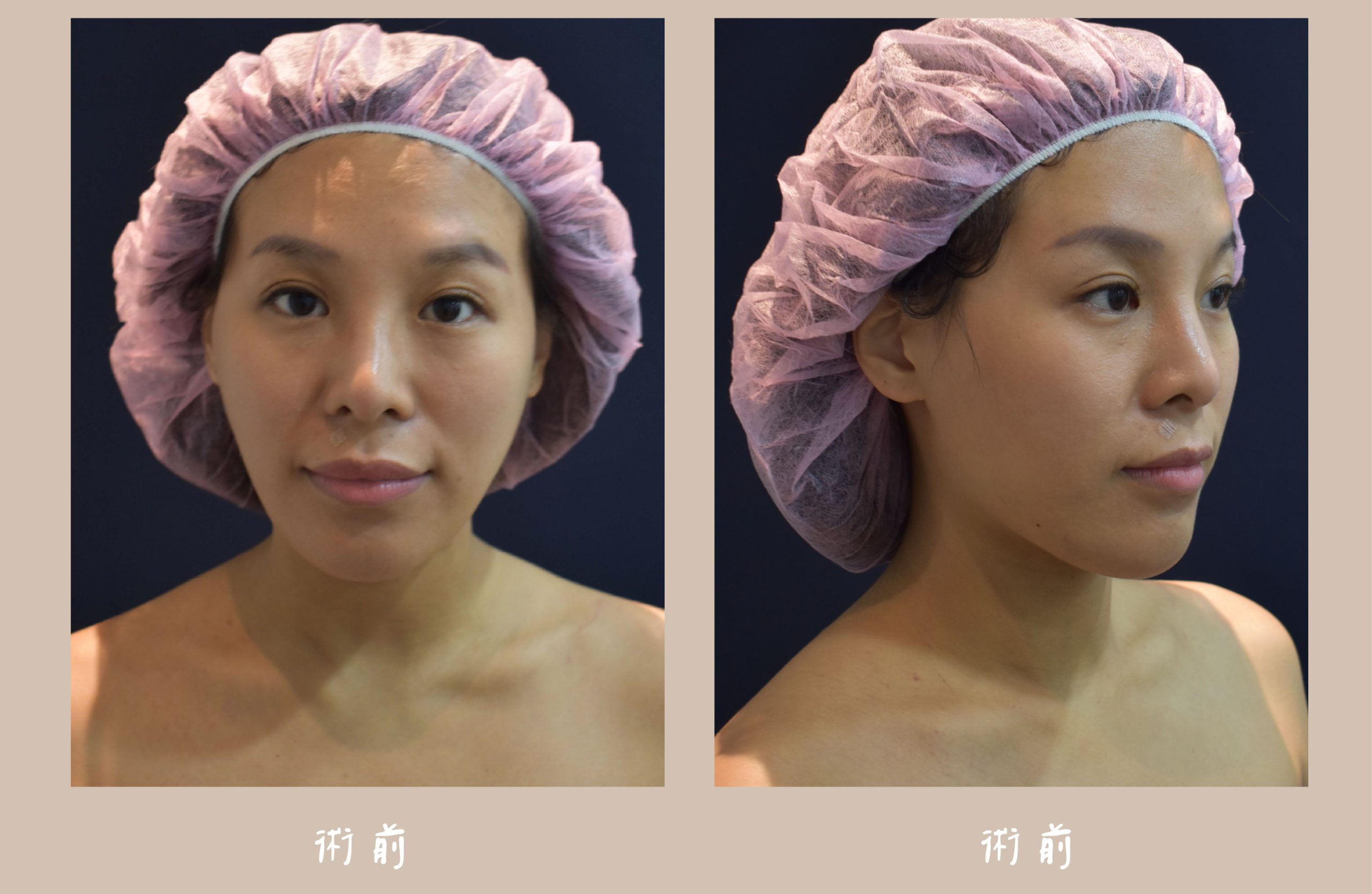 胡守丞醫師-臉部補脂術前