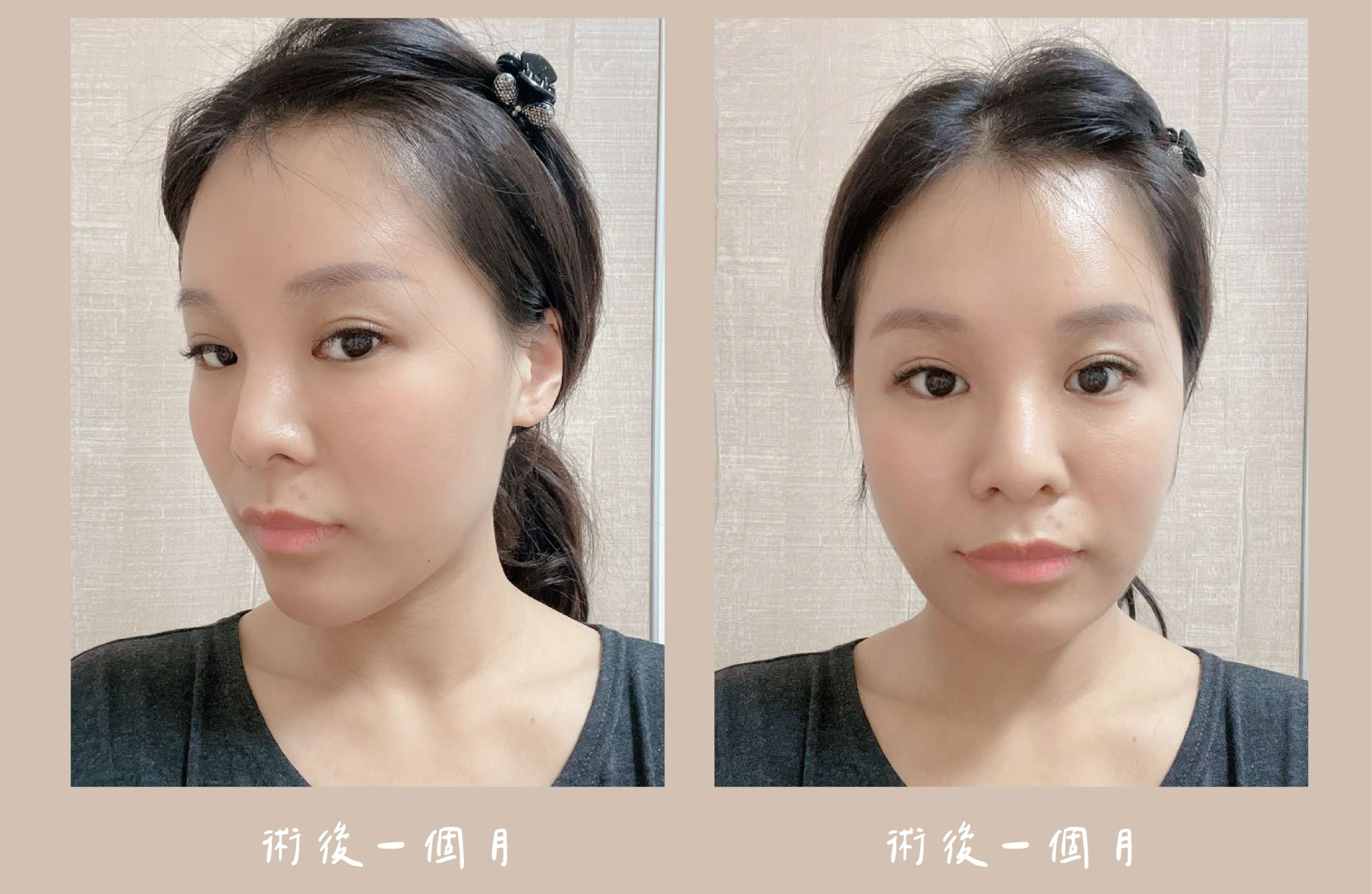 胡守丞醫師-臉部補脂_術後一個月