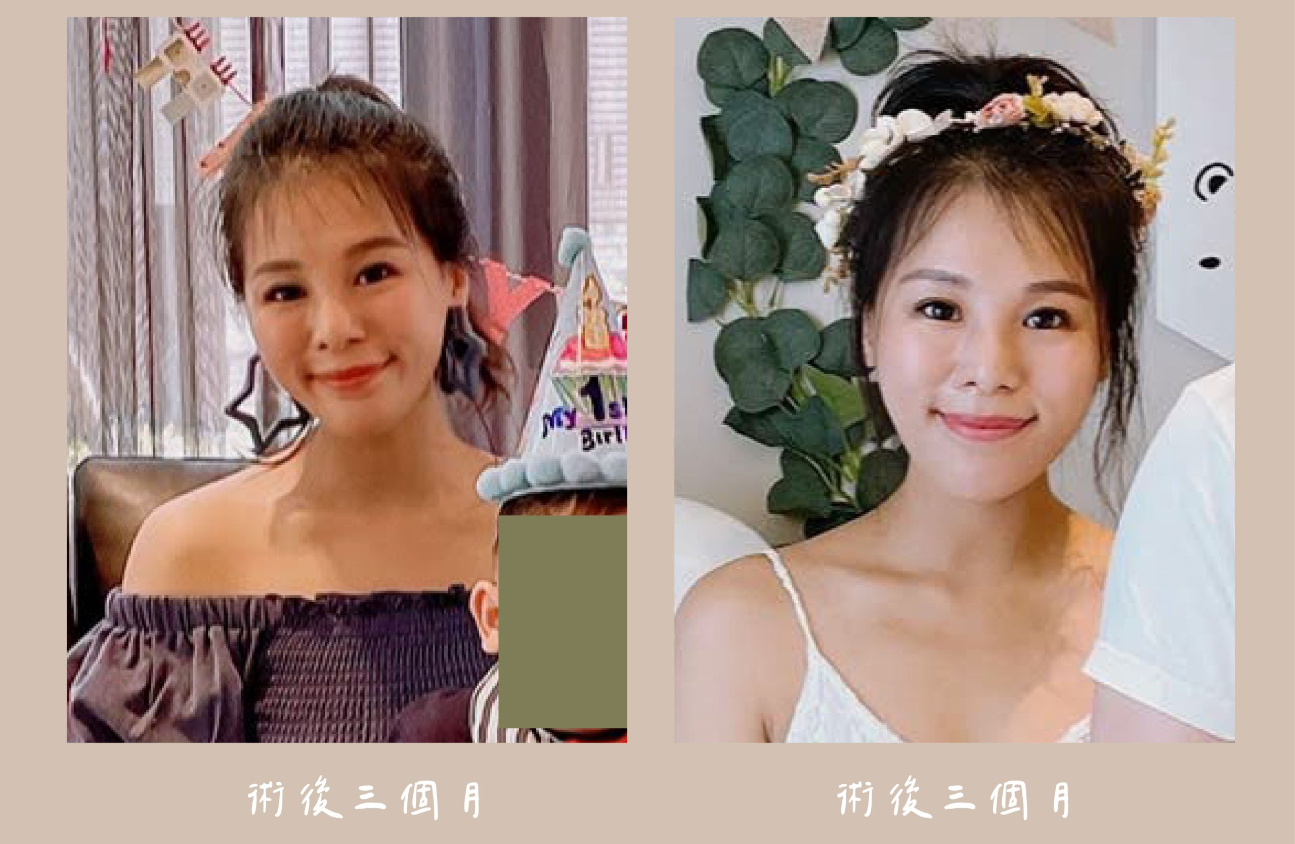 胡守丞醫師-臉部補脂_術後三個月