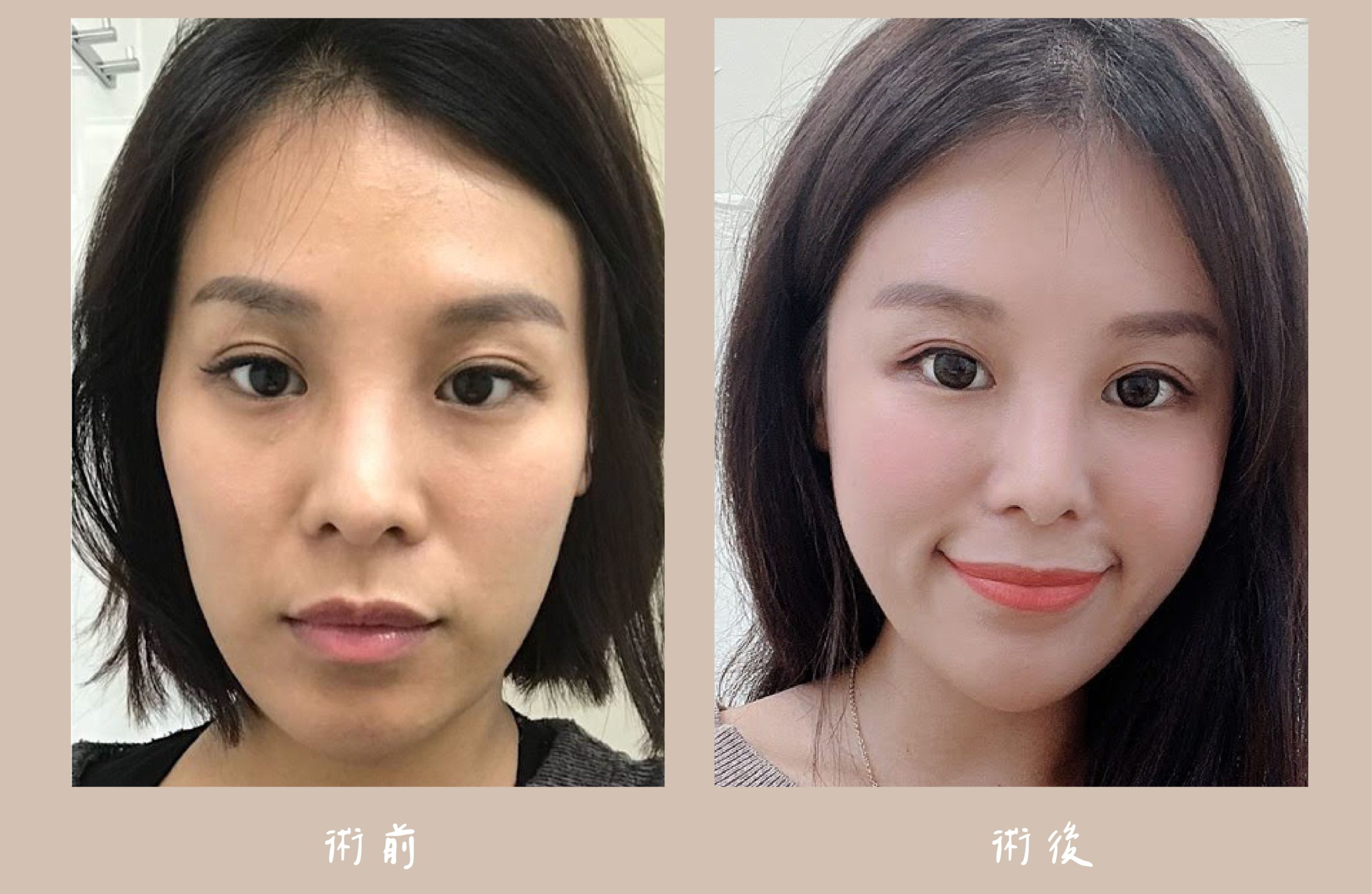 胡守丞醫師-臉部補脂_術前&術後