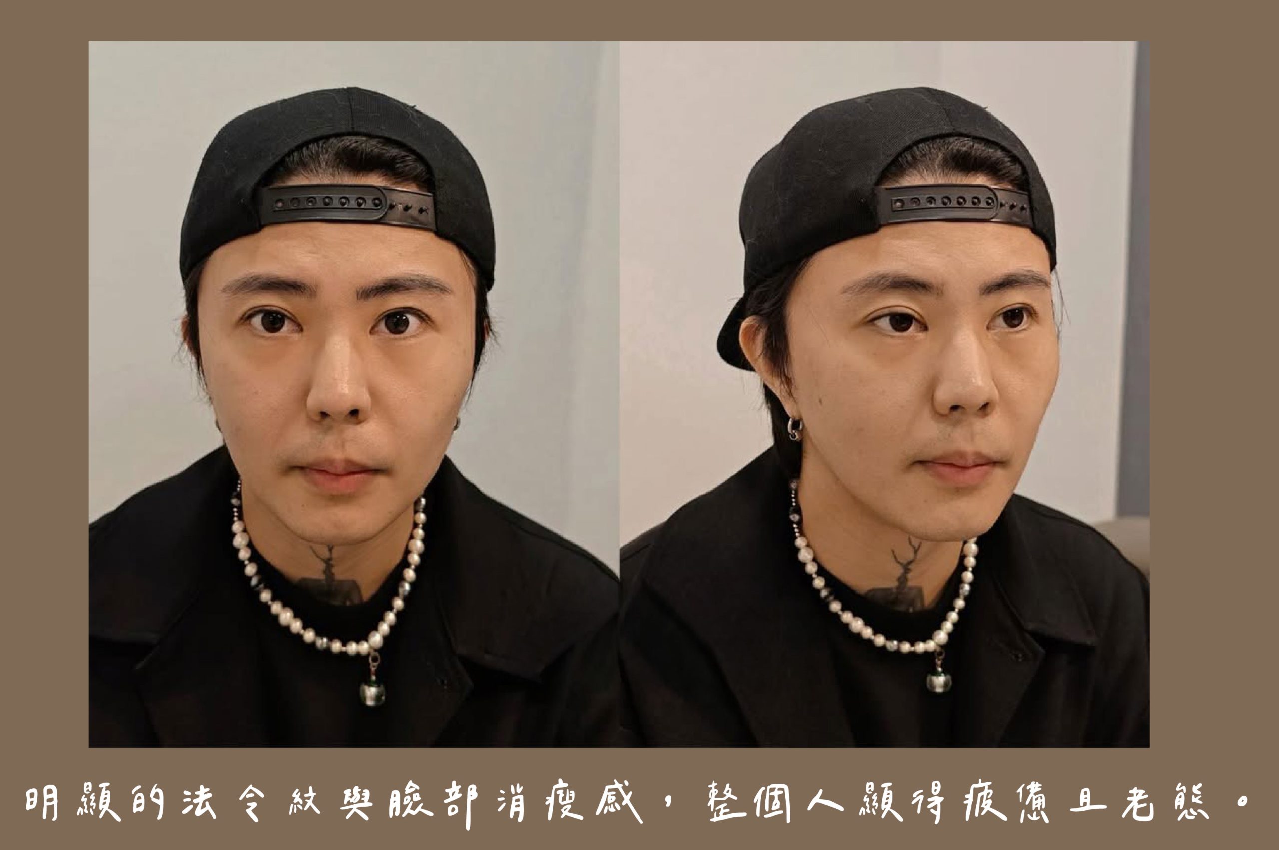 胡守丞醫師-瑞絲朗玻尿酸_術前